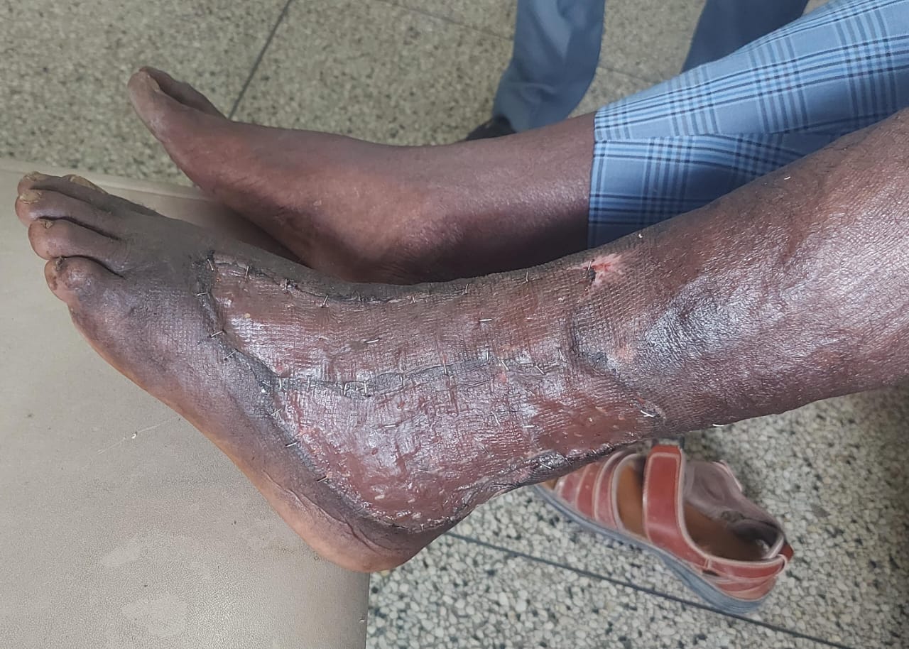 Post-operative split-thickness skin graft with evidence of successful take: minimal exudate, adherent edges, and viable graft bed. Demonstrates optimal healing progression for clinical reference.