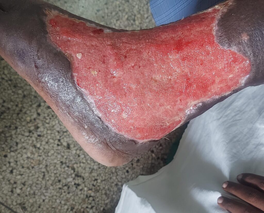 "A clinical close-up of a prepared wound site on a patient's skin, showing clean edges and healthy surrounding tissue, ready for an autologous skin grafting procedure. Medical professionals ensure optimal conditions for healing."